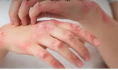 সিলেটে ছড়িয়ে পড়ছে স্কেবিস: তীব্র চুলকানিতে ভুগছে নারী-শিশুসহ হাজারো মানুষ 