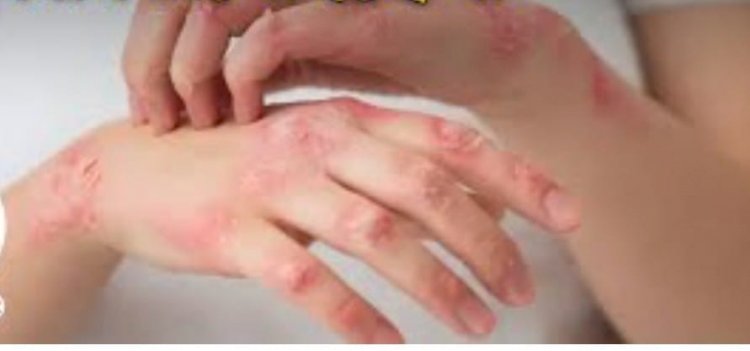 সিলেটে ছড়িয়ে পড়ছে স্কেবিস: তীব্র চুলকানিতে ভুগছে নারী-শিশুসহ হাজারো মানুষ 